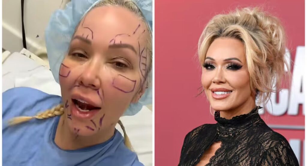 Bunnie Xo’s Facelift at 46 – Plastic Surgery Truth Revealed